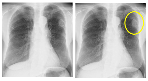 ステージ4の肺がんで余命３カ月だけど何か質問ある？