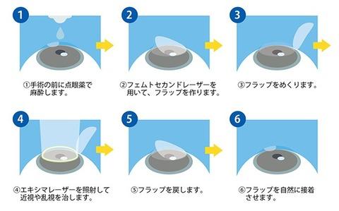 ３年前にレーシック手術したけど何か質問ある？