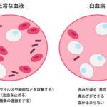 白血病を治療して完治したけど何か質問ある？