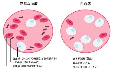 白血病を治療して完治したけど何か質問ある？