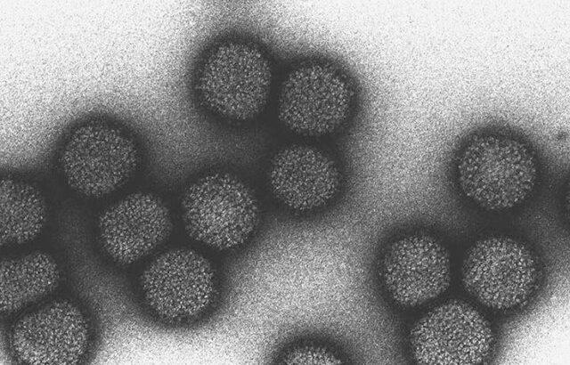 認知症はウイルス感染原因か、ウイルス性脳炎患者は31倍増