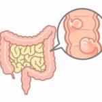 大腸がんステージ４を生き残ったけど何か質問ある？