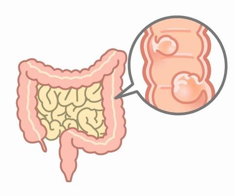 大腸がんステージ４を生き残ったけど何か質問ある？