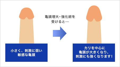 亀頭増大手術を受けたけど何か質問ある？