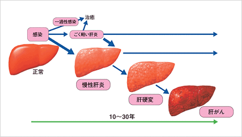 肝硬変で入院したことあるけど質問ある？