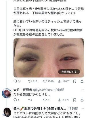 【悲報】クマ取り整形した女性、失明してしまう