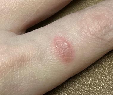 まだ電源入ってないトースターの金網に触れて熱ってなって火傷したんやが