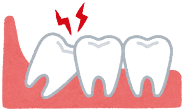 親知らず抜歯したんやが、痛すぎる😭