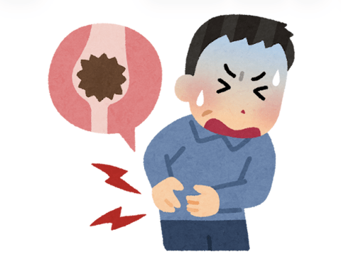 【悲報】ヤバい、尿路結石かもしれん…