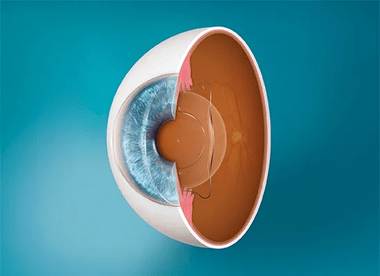 今月ICL手術を終えた僕氏の目の後遺症ｗｗｗ