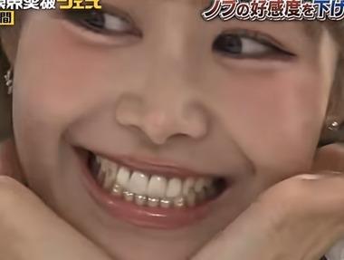 【画像】歯ジュエリーが流行ってるらしいな