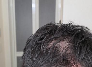 【画像】31歳ワイ、ちょっとハゲ始める😢