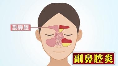 副鼻腔炎とかいう一生治らん病気