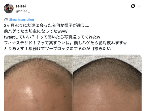 【画像】薄毛男性、ハゲ治療薬を半年飲み続けて無事復活