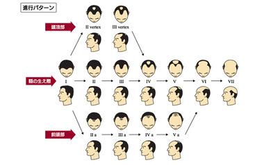 ワイちゃん、AGA治療を決意